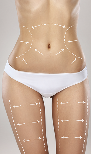 Cirugía plástica en Guadalajara: Servicio liposucción en Fernández cirugía plástica